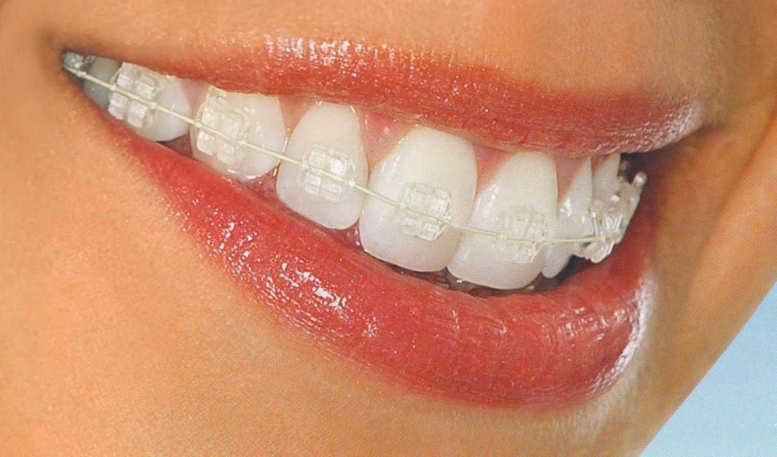 Ceramic braces are also called Invisible braces